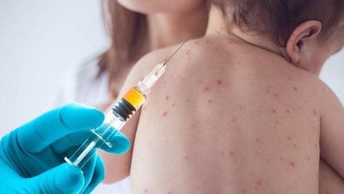 Những lưu ý phòng ngừa lây nhiễm sởi trong cơ sở y tế